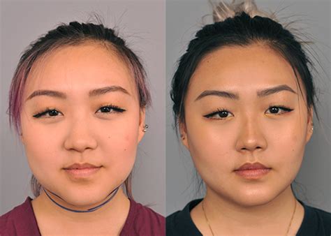 buccal fat removal face